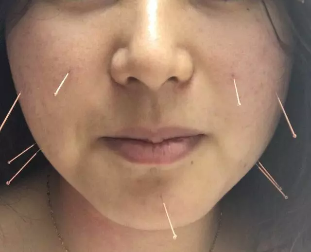 Yu' s Acupuncture